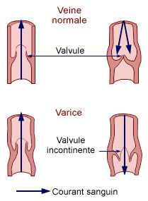 Varices